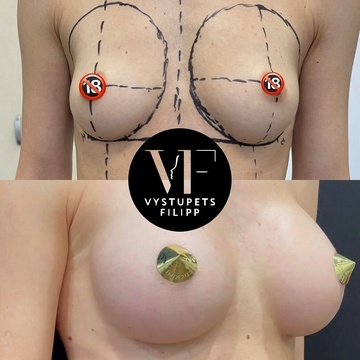 Увеличение груди в Москве, пластический хирург Филипп Выступец